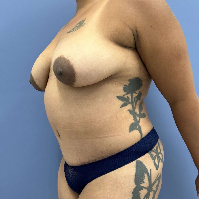 after tummy tuck 45 degrees left angle case 3754