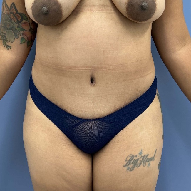 after tummy tuck front case 3754