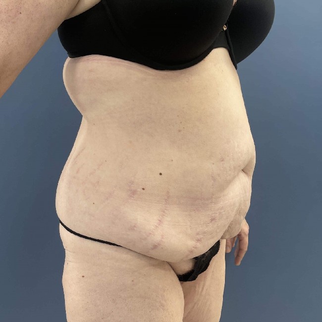 before tummy tuck with bbl - 45 degrees right angle case 3761