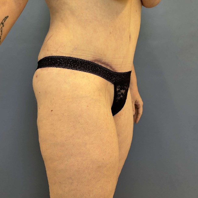 after tummy tuck with bbl - 45 degrees right angle case 3761