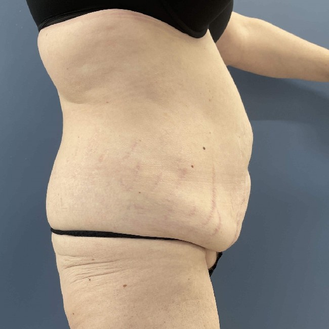 before tummy tuck with bbl - right angle case 3761