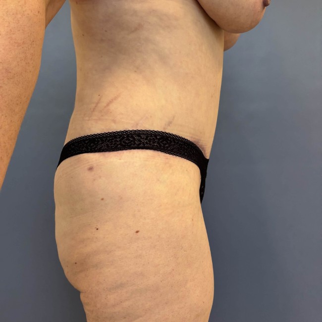 after tummy tuck with bbl - right angle case 3761