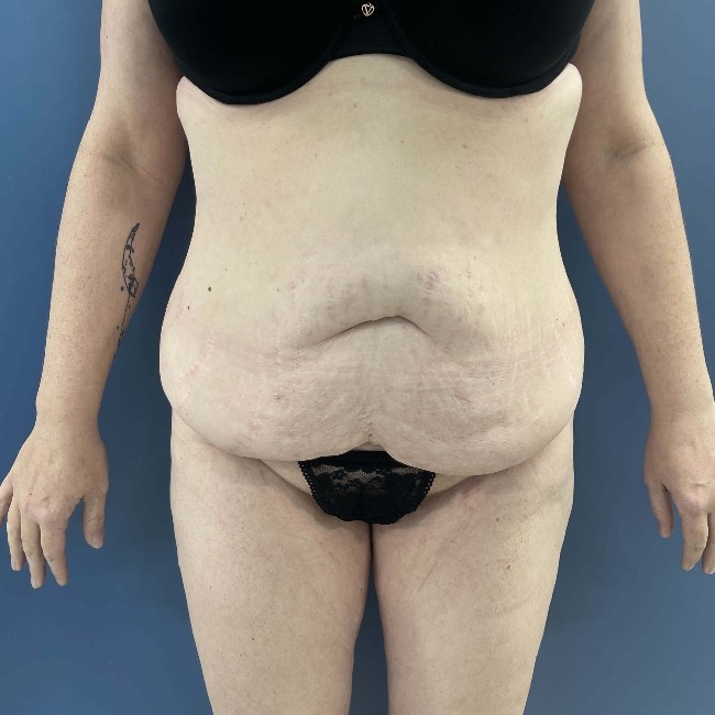 before tummy tuck with bbl - front view case 3761