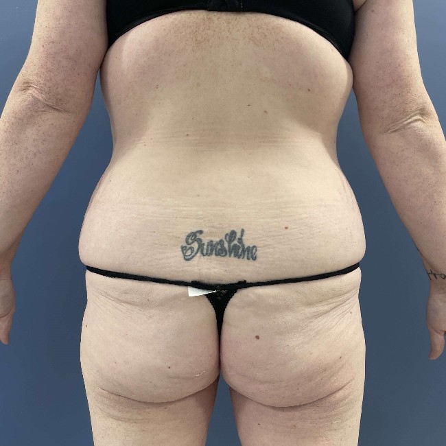 before tummy tuck with bbl - back view case 3761