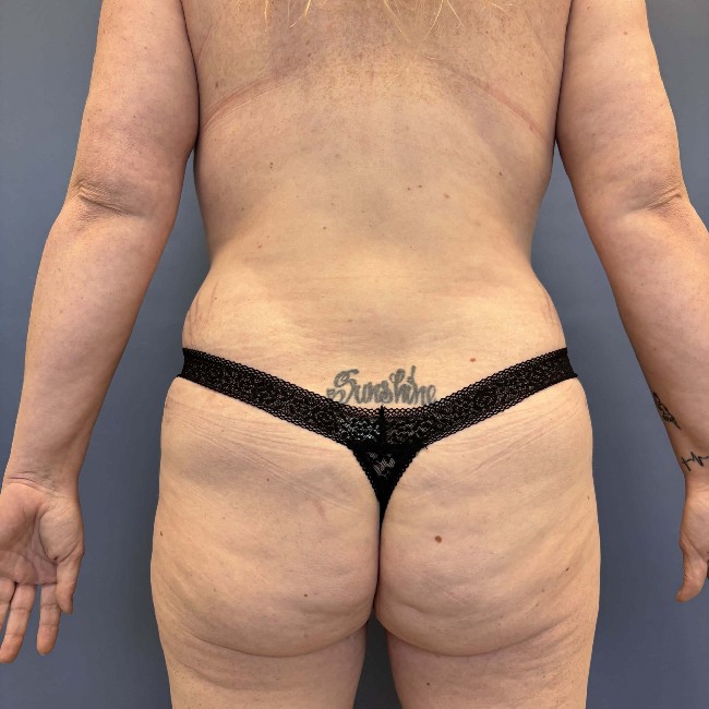 after tummy tuck with bbl - back view case 3761