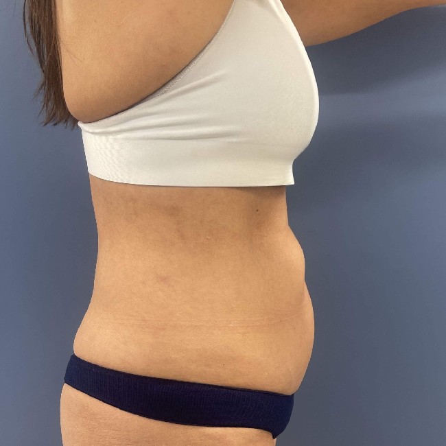 before tummy tuck - vaser liposuction right angle case 3770