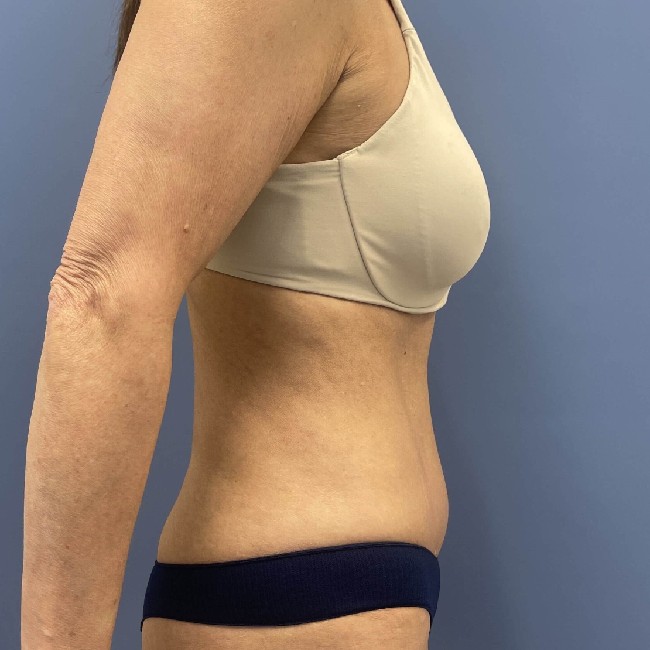 after tummy tuck - vaser liposuction left angle case 3770