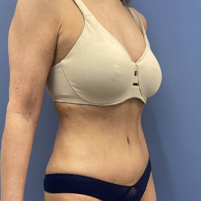 after tummy tuck - vaser liposuction 45 degrees right angle case 3770