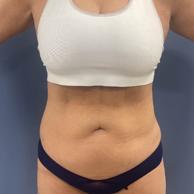 before tummy tuck - vaser liposuction front view case 3770