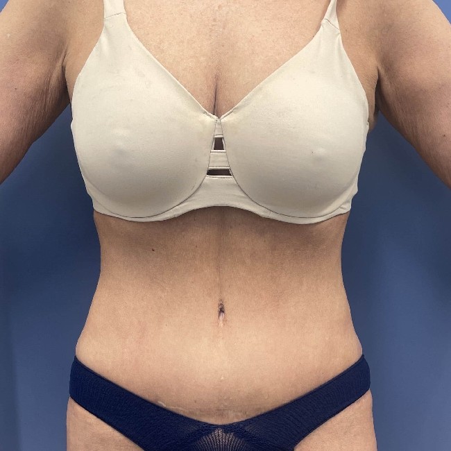 after tummy tuck - vaser liposuction front view case 3770
