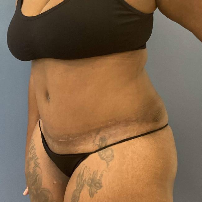 after tummy tuck - flatter abs 45 degrees left angle case 3779