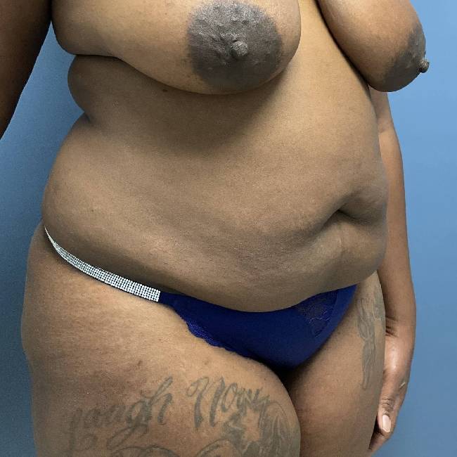 before tummy tuck - flatter abs 45 degrees right angle case 3779