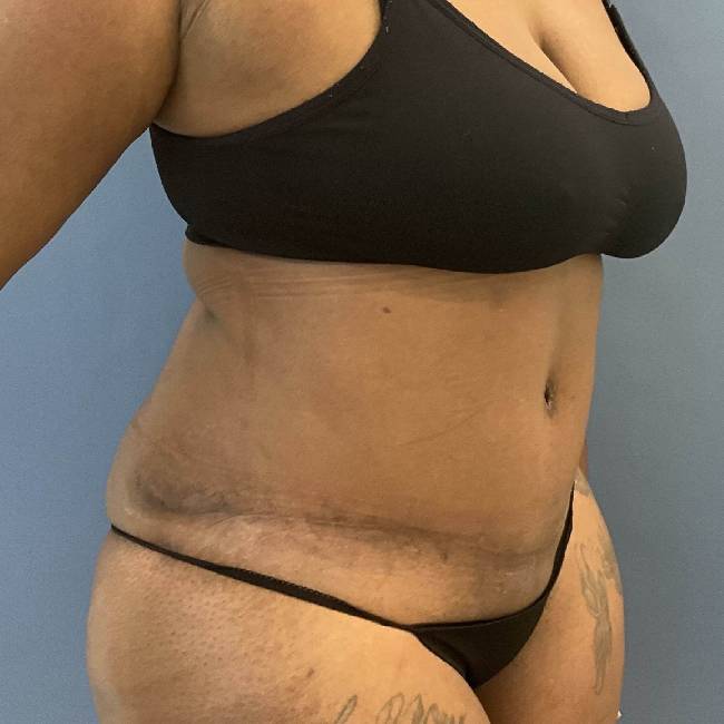 after tummy tuck - flatter abs 45 degrees right angle case 3779