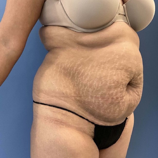 before tummy tuck - lipo-abdominoplasty 45 degrees right angle case 3786