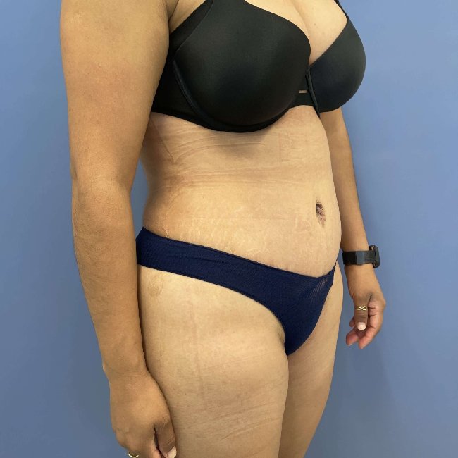 after tummy tuck - lipo-abdominoplasty 45 degrees right angle case 3786