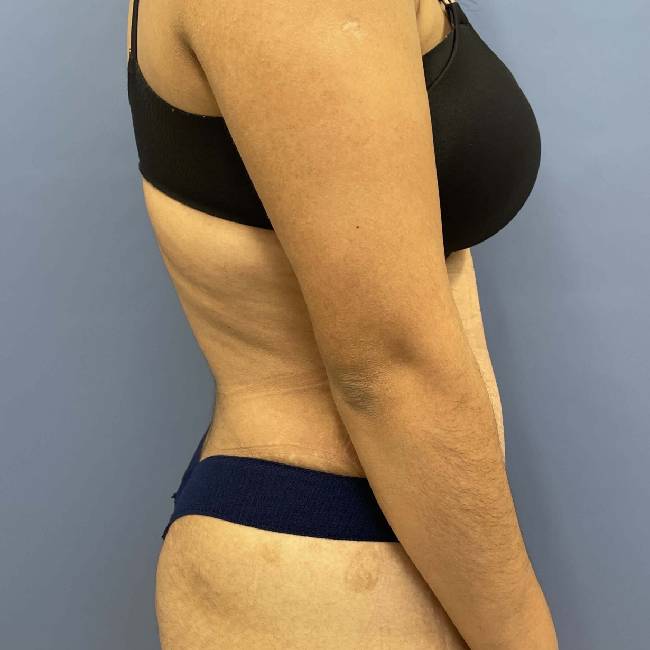 after tummy tuck - lipo-abdominoplasty right angle case 3786