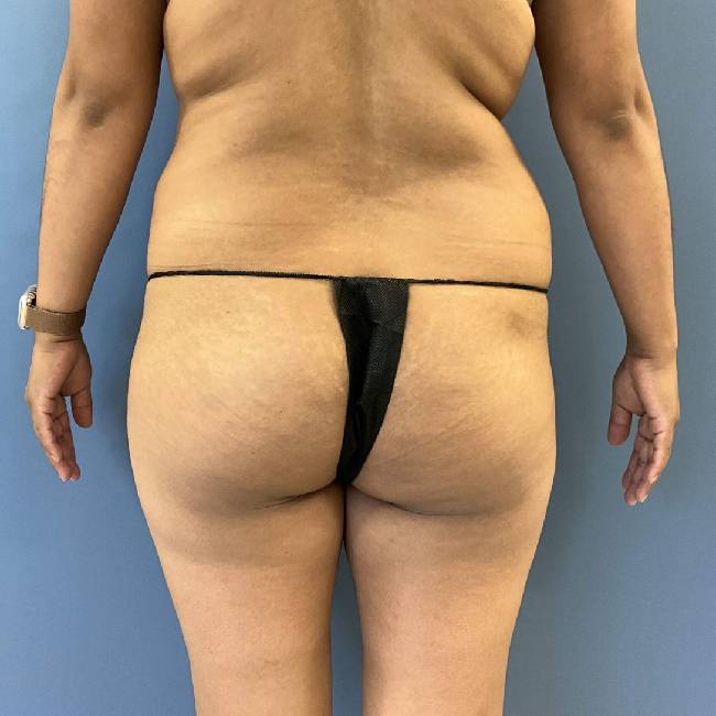 before tummy tuck - lipo-abdominoplasty back view case 3786