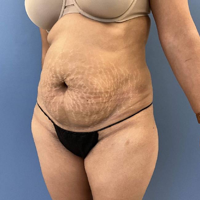 before tummy tuck - lipo-abdominoplasty 45 degrees left angle case 3786