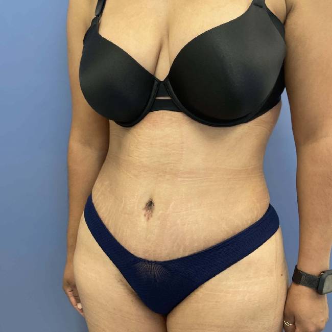 after tummy tuck - lipo-abdominoplasty 45 degrees left angle case 3786