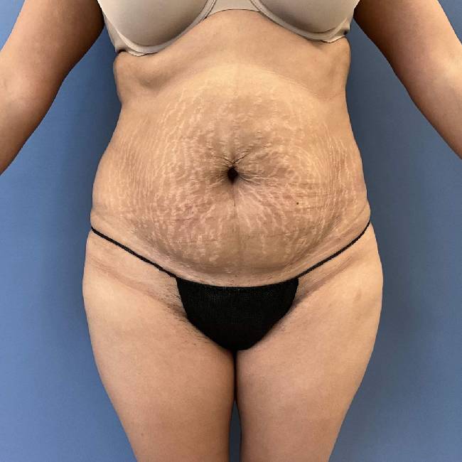 before tummy tuck - lipo-abdominoplasty front view case 3786