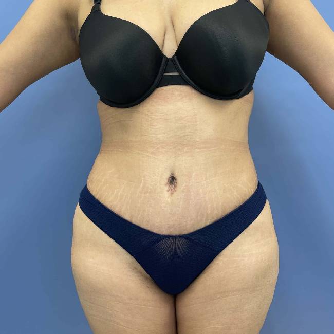 after tummy tuck - lipo-abdominoplasty front view case 3786