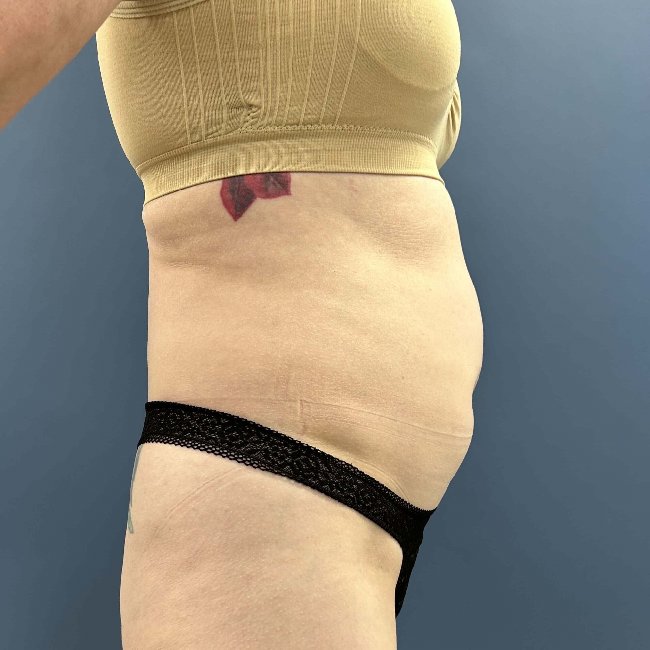 before tummy tuck - skinny BBL right angle case 3797