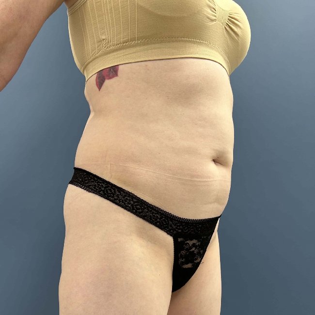 before tummy tuck - skinny BBL 45 degrees right angle case 3797