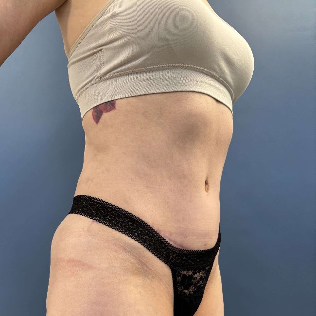 after tummy tuck - skinny BBL 45 degrees right angle case 3797