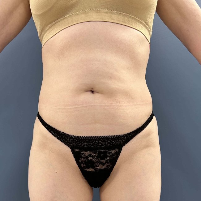 before tummy tuck - skinny BBL front view case 3797