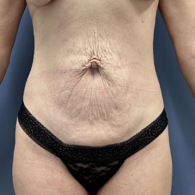 before tummy tuck - stretch marks treatment front view case 3806