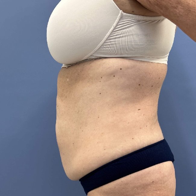 before abdominoplasty - tummy tuck left angle case 3813