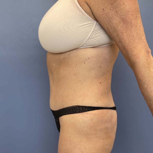 after abdominoplasty - tummy tuck left angle case 3813