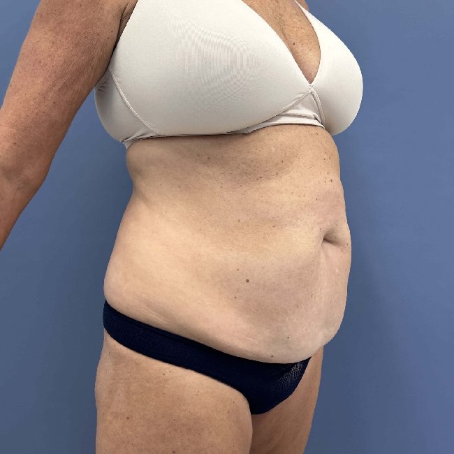 before abdominoplasty - tummy tuck 45 degrees right angle case 3813