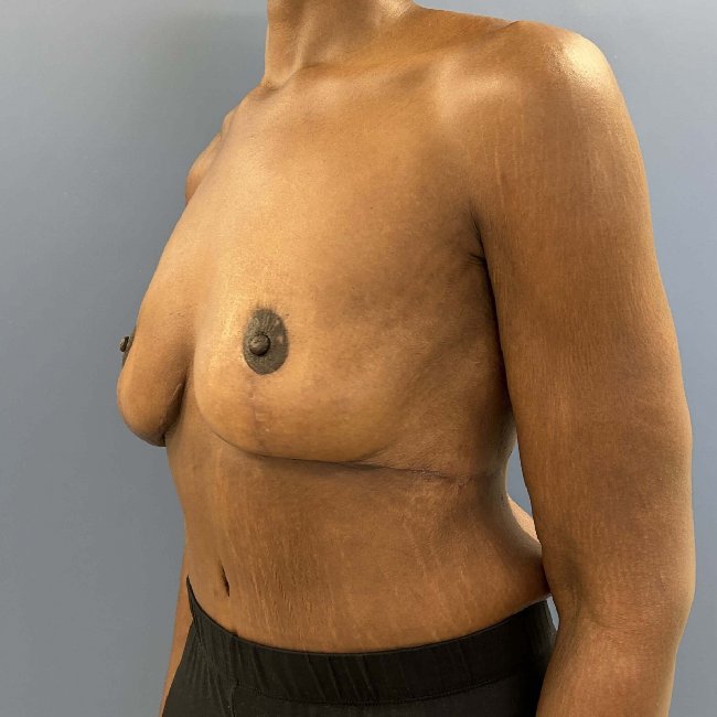 after After Weight Loss Surgery female patient Left 45 angle view case 5429