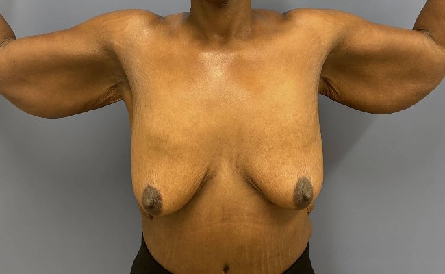 before After Weight Loss Surgery female patient front view case 5429