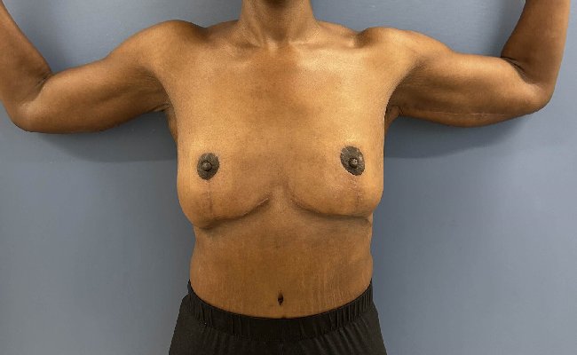 after Image After Weight Loss Surgery female patient front view case 5429