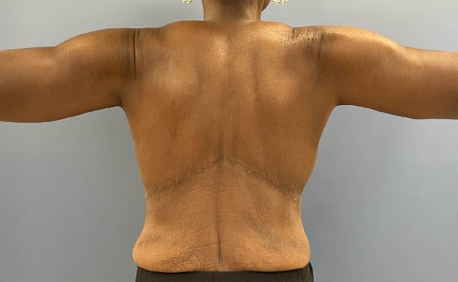 after Image After Weight Loss Surgery female patient back view case 5429
