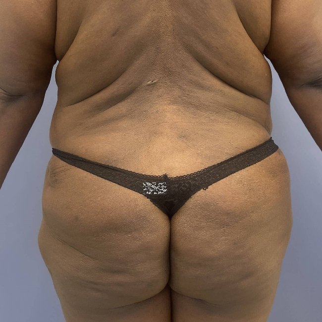 after After Weight Loss Surgery female patient back view case 5437