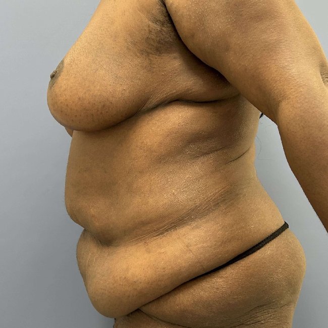 before After Weight Loss Surgery female patient left side view case 5437