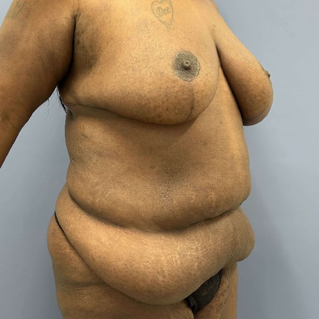 before After Weight Loss Surgery female patient right angle view case 5437