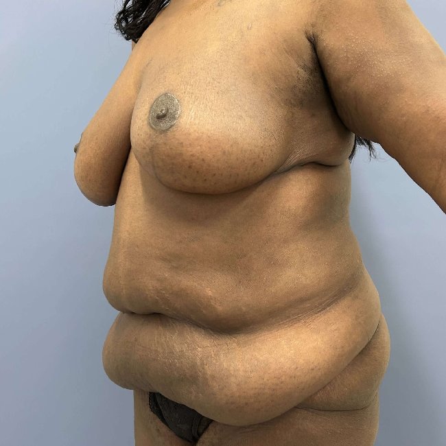 before After Weight Loss Surgery female patient left angle view case 5437