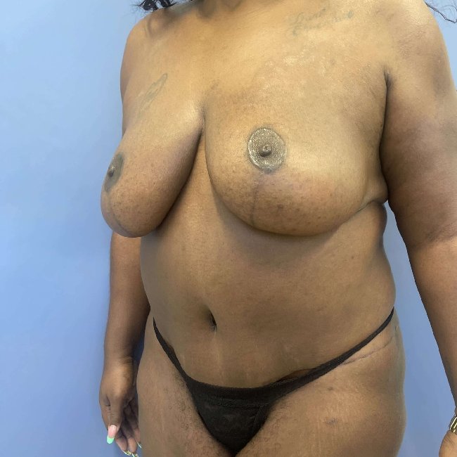 after After Weight Loss Surgery female patient left angle view case 5437