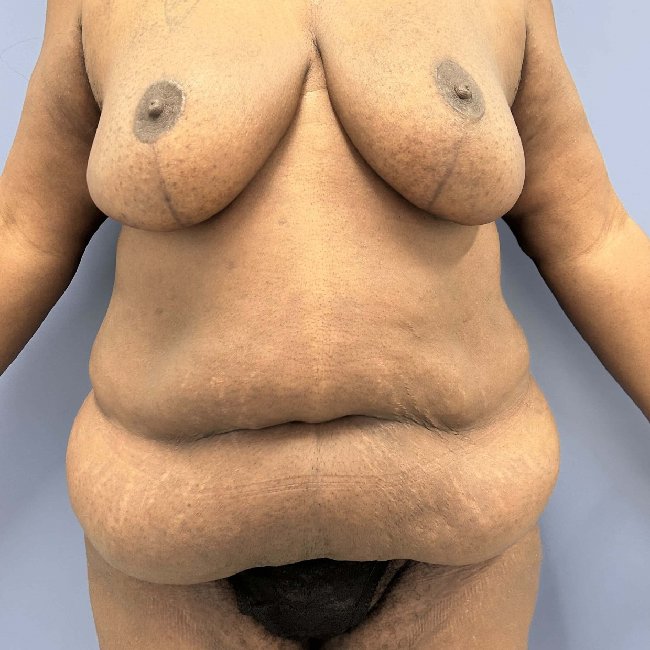 before After Weight Loss Surgery female patient front view case 5437