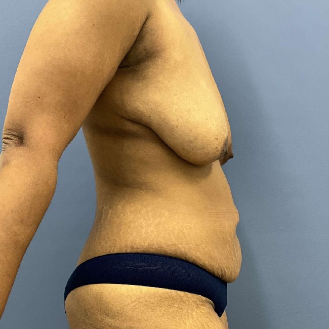 before mommy makeover right side view female patient case 5448