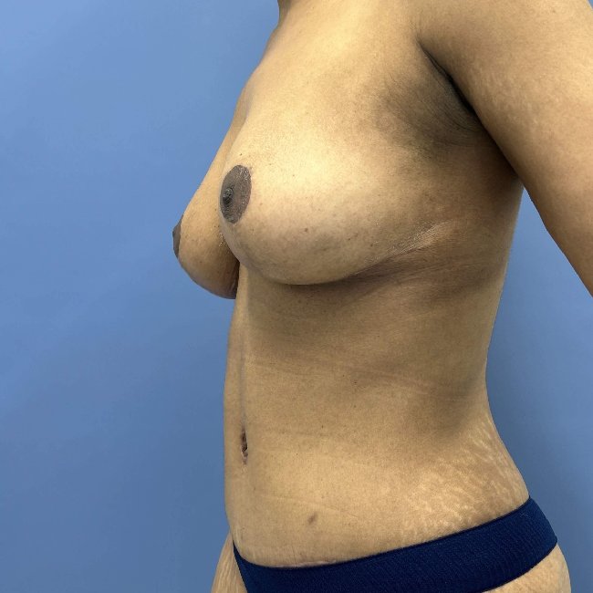 after mommy makeover left view female patient case 5448