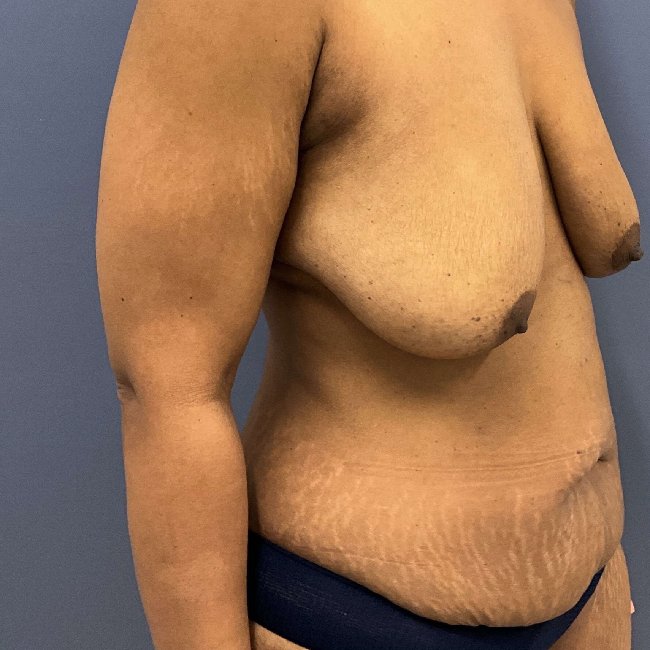before mommy makeover right angle view female patient case 5448