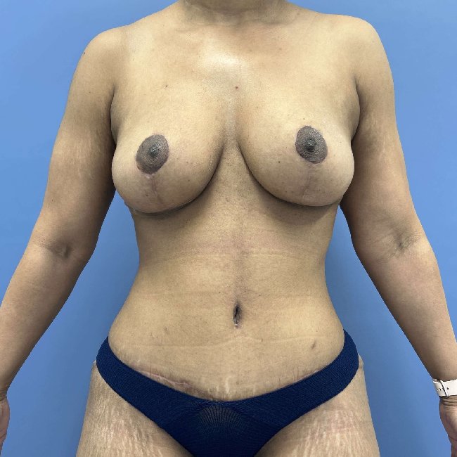 after mommy makeover front view female patient case 5448