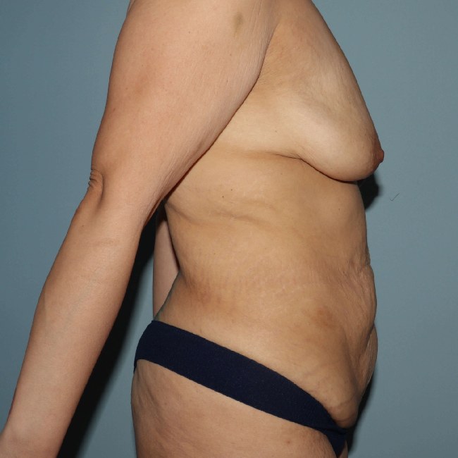 before mommy makeover right side view female patient case 6138