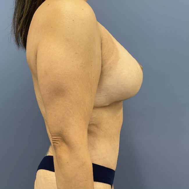 after mommy makeover right side view female patient case 6138