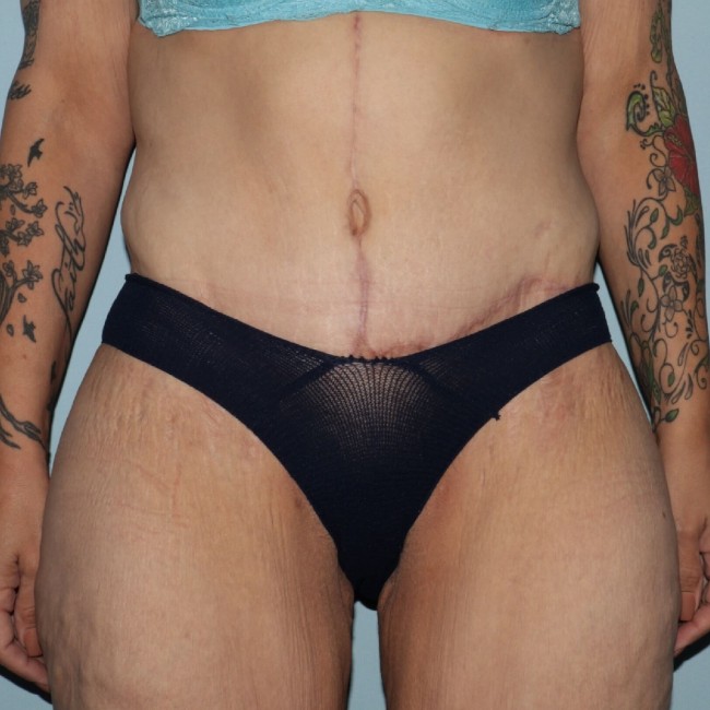 after fleur-de-lis abdominoplasty front view female patient case 7774